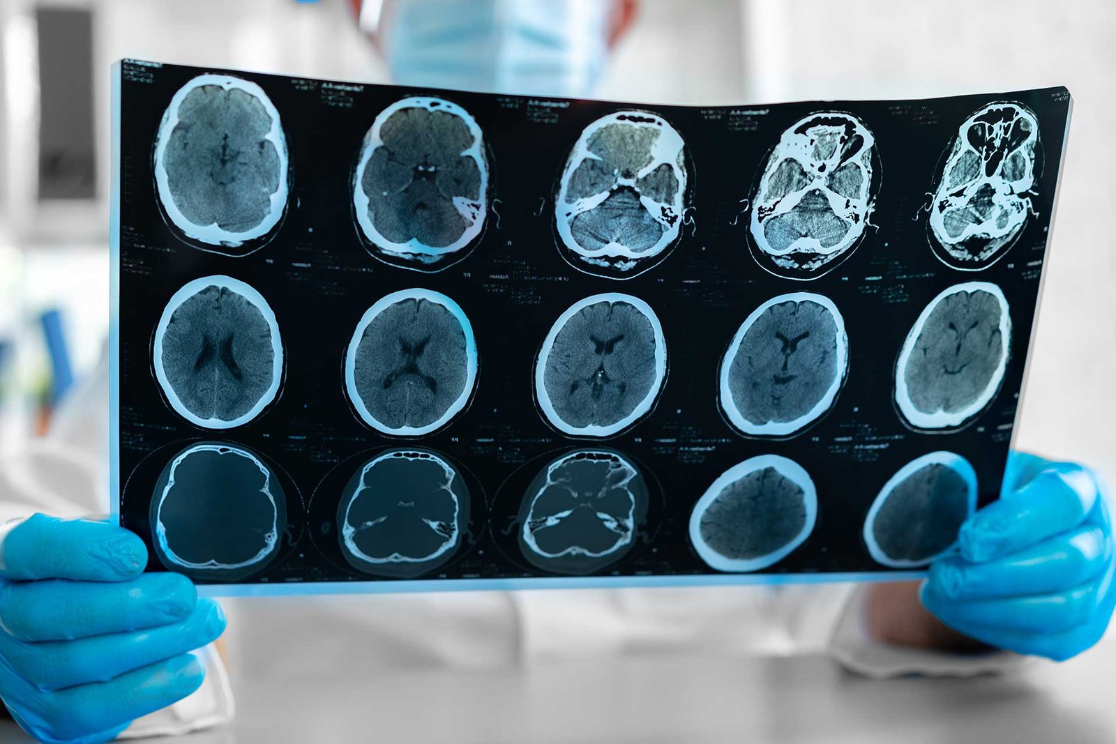 Neurological Disorders
